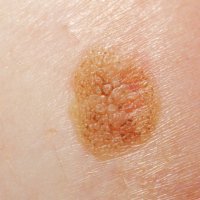 Медики: Открыт новый способ лечения меланомы кожи