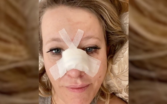 «У меня перелом носа»: Ксения Собчак показала лицо после операции