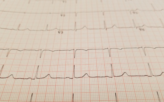 Кардиологи назвали способ проверить сердце без врача